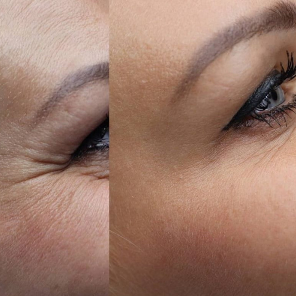 EverYouthCosmetica - Eye Area Refinement Treatment - Results