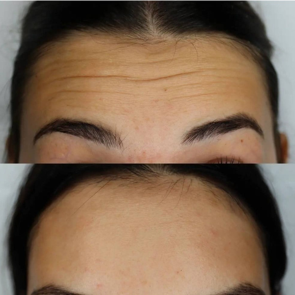 EverYouthCosmetica - Forehead - Treatment - Results