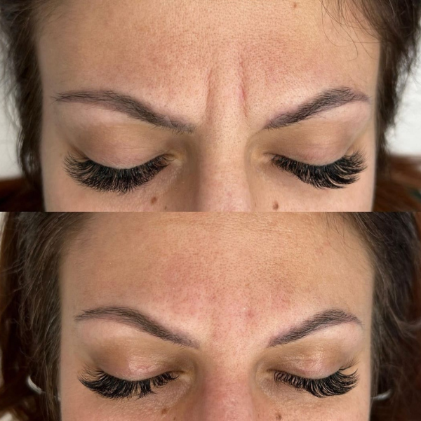 EverYouthCosmetica - Frown Line Refinement Treatment - Results